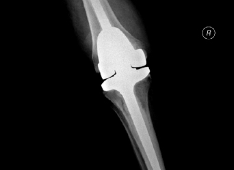 xray of a successful Total Knee Replacement